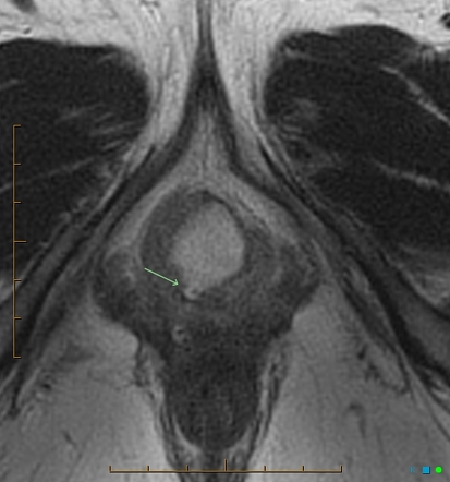 Skene Gland Cyst Image Radiopaedia Org