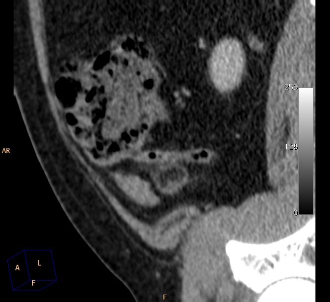 Epiploic Appendagitis Of The Vermiform Appendix Image