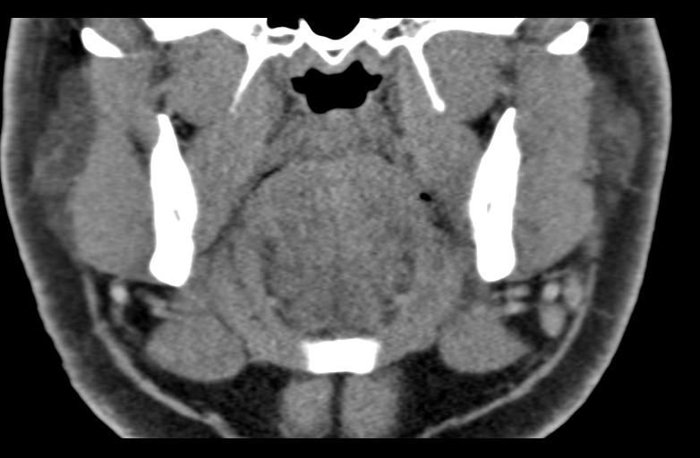 Unicystic Ameloblastoma Maxilla