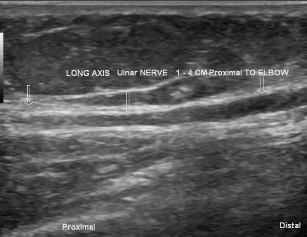 Ulnar nerve compression | Image | Radiopaedia.org