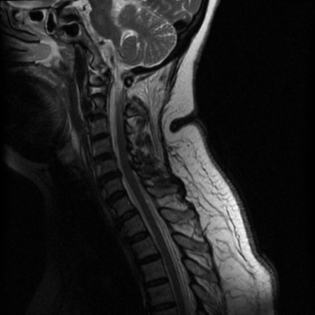 Craniocervical junction distraction injury | Image | Radiopaedia.org