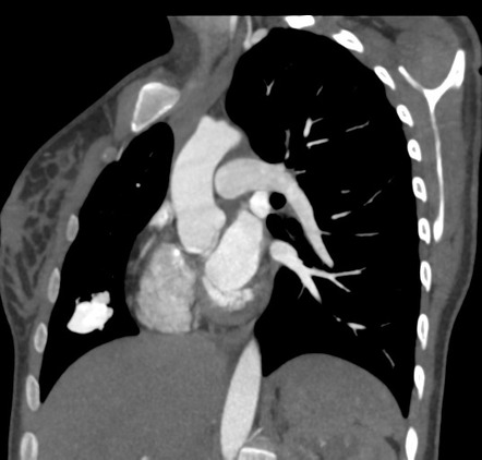 Pulmonary arteriovenous malformation | Image | Radiopaedia.org