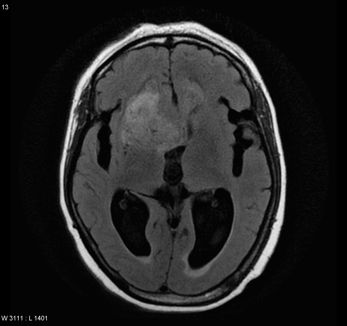 Glioblastoma NOS | Image | Radiopaedia.org