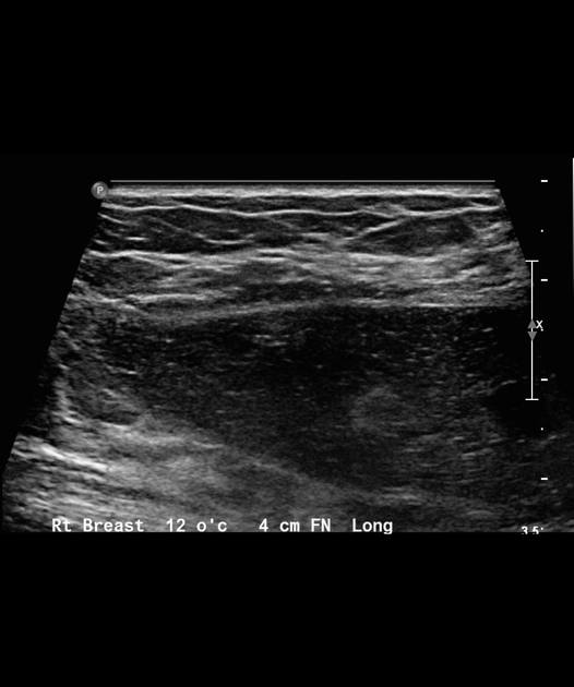 Injected breast augmentation Radiology Case Radiopaedia