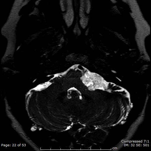 Epidermoid Cyst Cerebellopontine Angle Image 9046