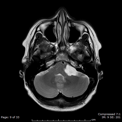 Epidermoid Cyst Cerebellopontine Angle Image 1942