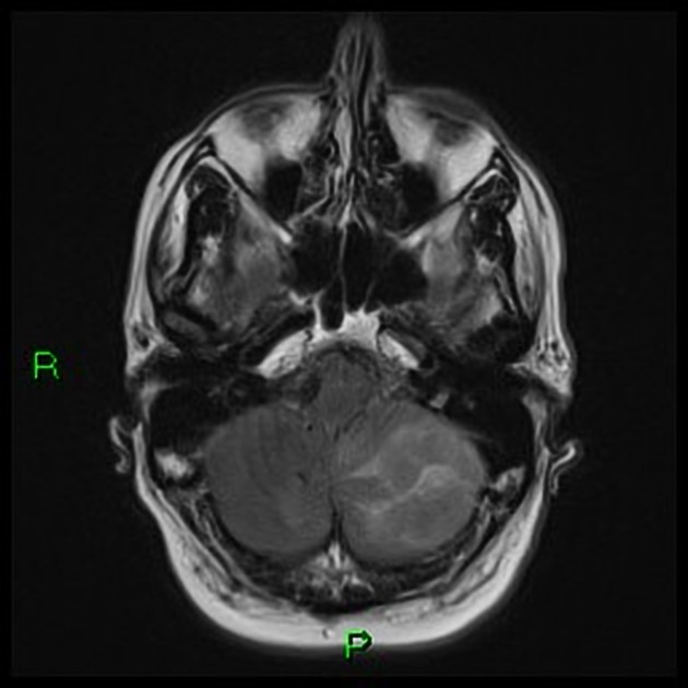 Acute cerebellitis | Radiology Reference Article | Radiopaedia.org