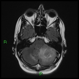 Primary CNS lymphoma (cerebellar) | Image | Radiopaedia.org