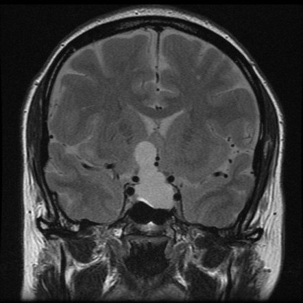 Rathke's cleft cyst - huge | Radiology Case | Radiopaedia.org