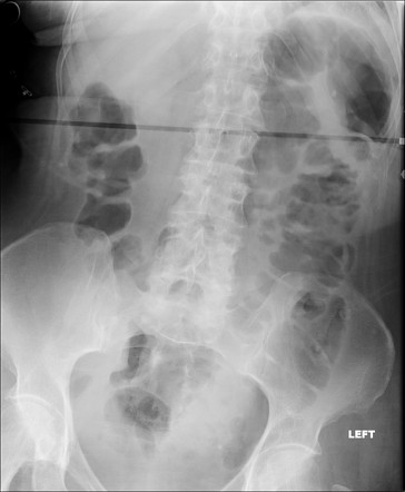 Neo-terminal ileal stricture - Crohn disease | Radiology Case ...