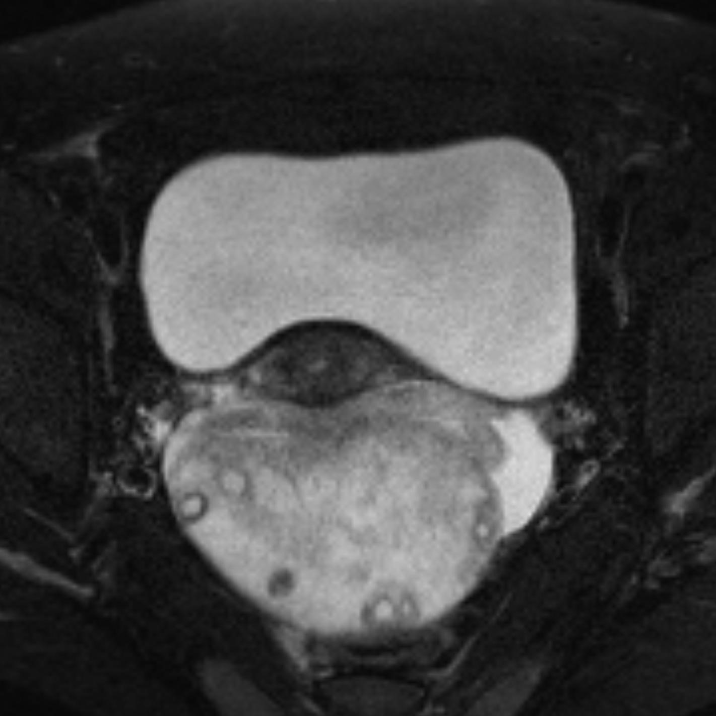 ovarian-torsion-image-radiopaedia