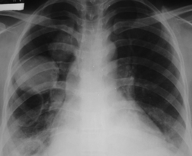 Hemithorax white-out (differential)