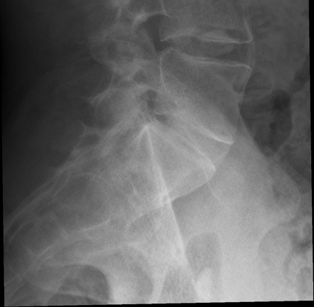 Ankylosing spondylitis | Image | Radiopaedia.org