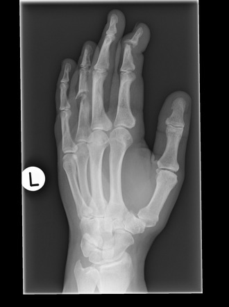 oblique bone fracture