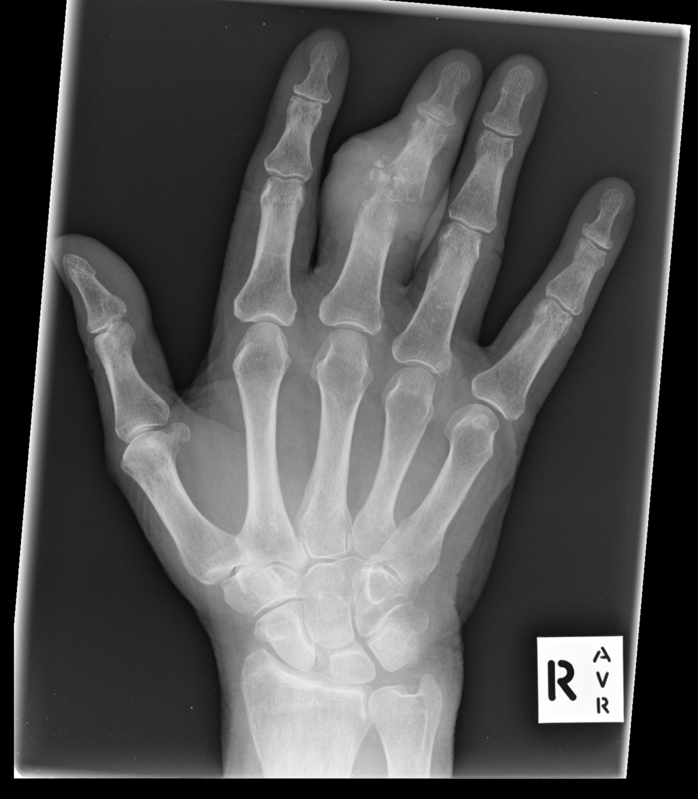 Gouty arthropathy | Image | Radiopaedia.org