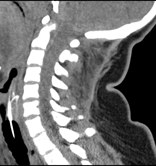 Atlanto-occipital dissociation | Image | Radiopaedia.org