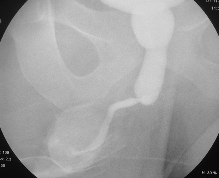 Urethrography Radiology Reference Article Radiopaedia Org