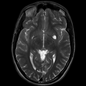 Perivascular spaces | Radiology Reference Article | Radiopaedia.org