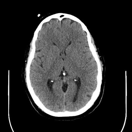 Pituitary Apoplexy 