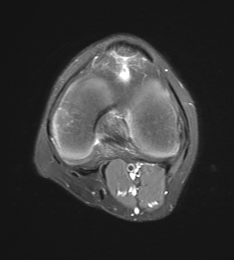 Osgood-Schlatter disease | Image | Radiopaedia.org