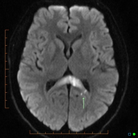 Cytotoxic lesions of the corpus callosum (CLOCCs) | Radiology Reference ...