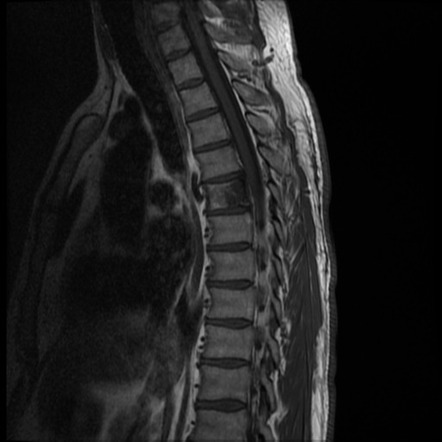 Aggressive spinal hemangioma | Image | Radiopaedia.org