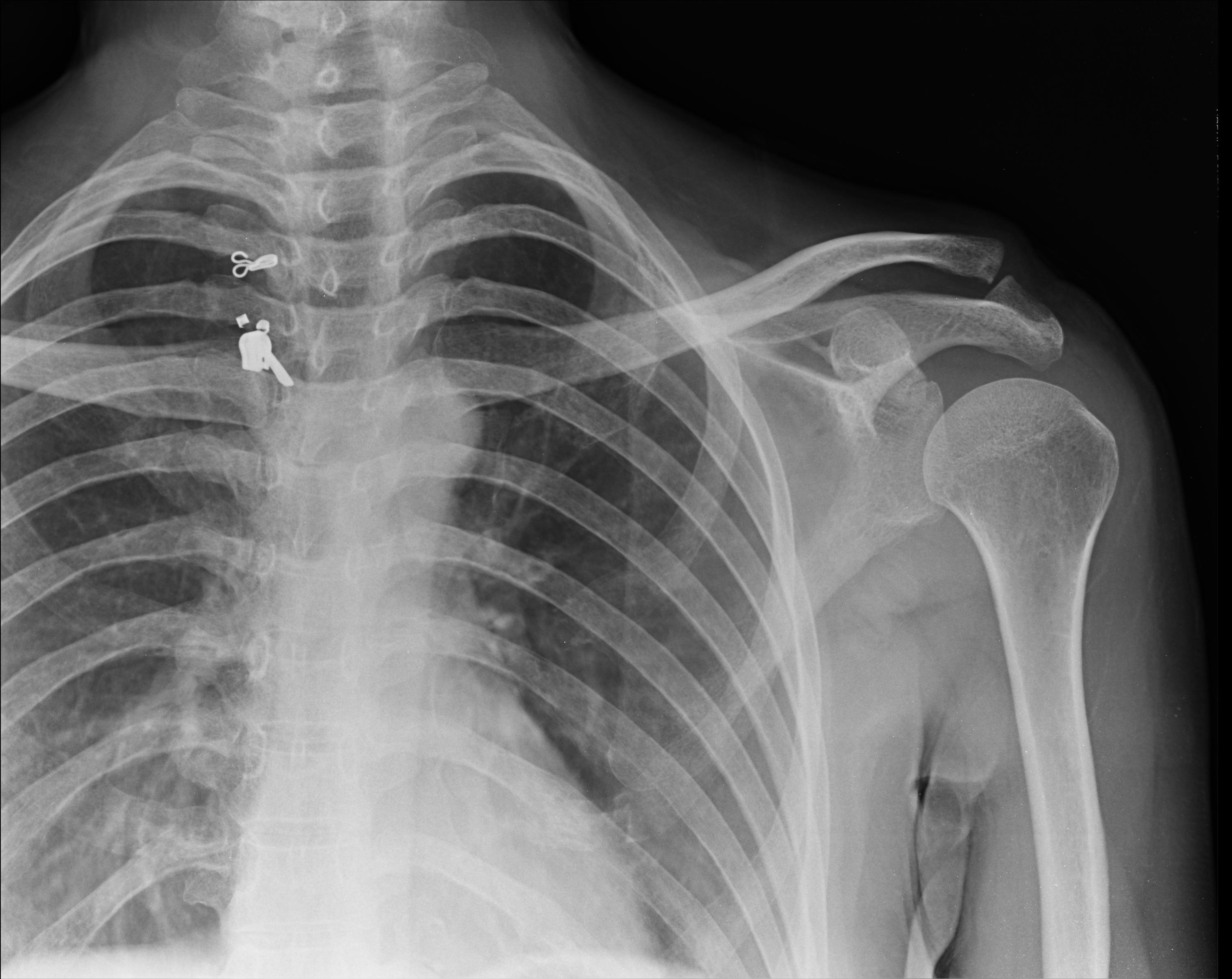 Right Shoulder X Ray Views at Anja Flores blog