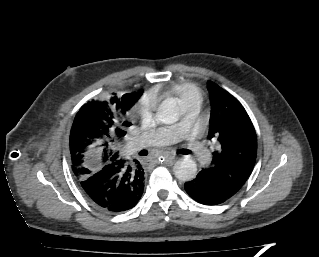 Esophageal Perforation 