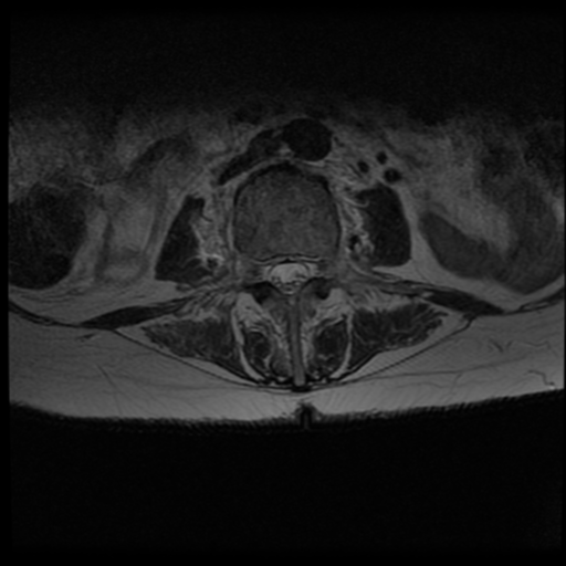 Spinal Discitis Osteomyelitis Image