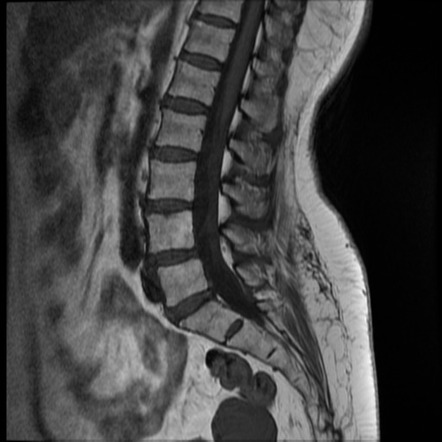 Fibrous dysplasia of lumbar spine | Image | Radiopaedia.org