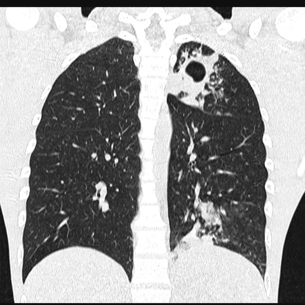 Tuberculosis (pulmonary Manifestations) | Radiology Reference Article ...