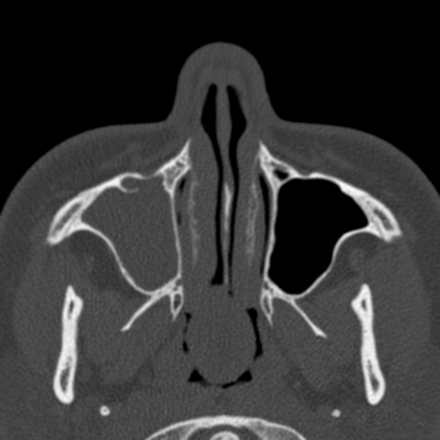 Antrochoanal polyp deals