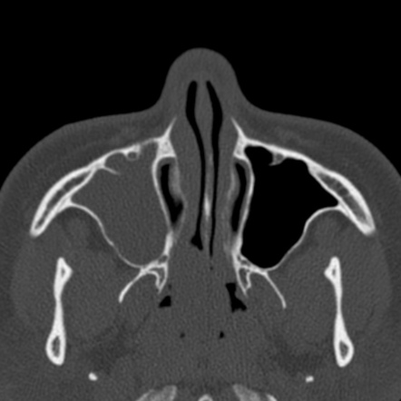 Antrochoanal polyp | Radiology Case | Radiopaedia.org