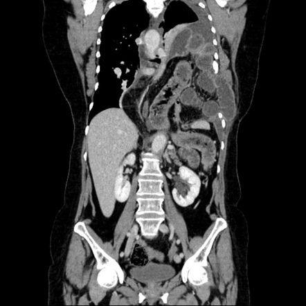 Intestinal obstruction due to diaphragmatic hernia | Radiology Case ...