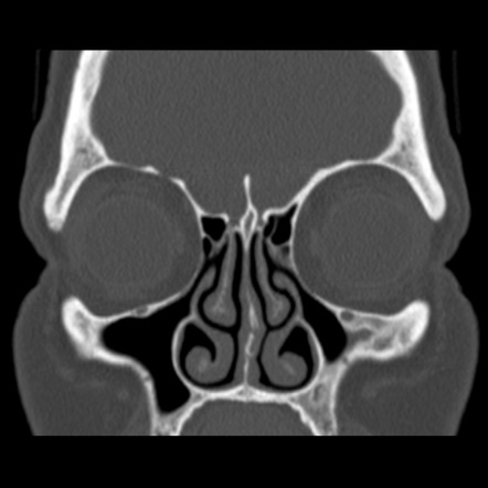 Nasolabial cyst | Image | Radiopaedia.org