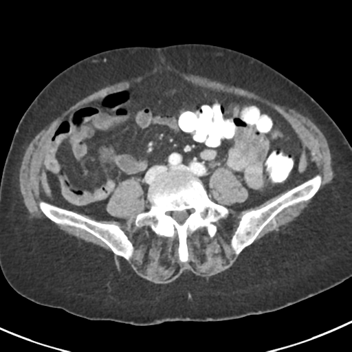 Ampullary adenocarcinoma | Image | Radiopaedia.org