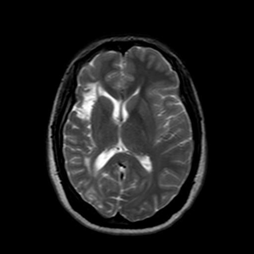 Post-encephalitis gliosis | Image | Radiopaedia.org