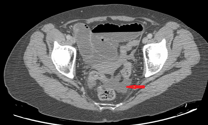 Small bowel obstruction by Meckel diverticulum and omphalomesenteric ...