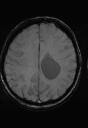 Intraventricular simple cyst | Image | Radiopaedia.org