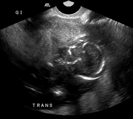 Fetal death in utero | Radiology Reference Article | Radiopaedia.org