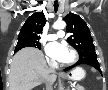 Bifid rib | Radiology Case | Radiopaedia.org