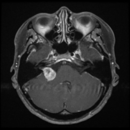 Acoustic neuroma | Radiology Case | Radiopaedia.org