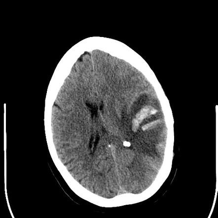 Haemorrhagic venous infarct | Radiology Case | Radiopaedia.org