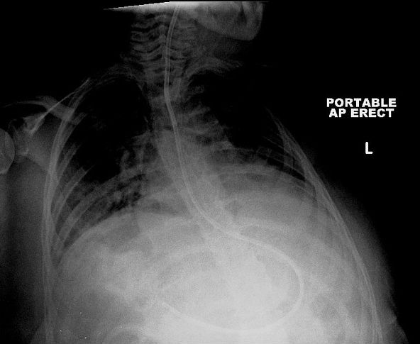 Nasogastric Tube Positioning | Image | Radiopaedia.org