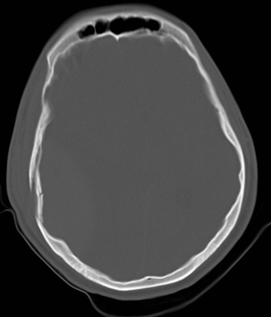 Extradural Hemorrhage Image