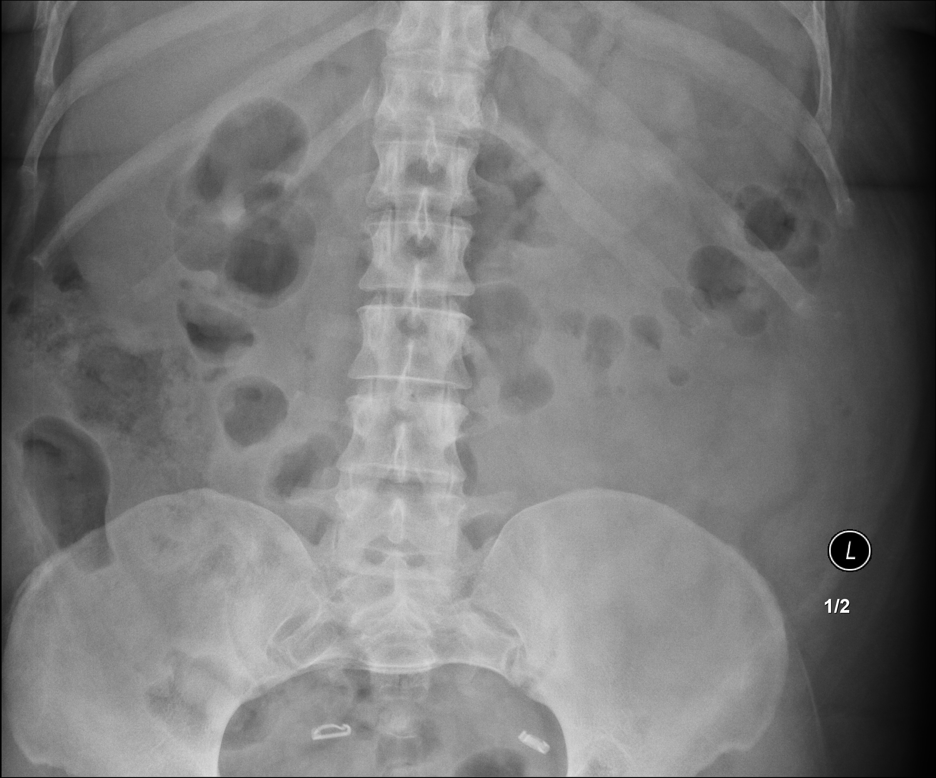 Normal Abdominal X Ray