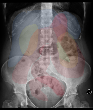 Abdominal X-ray Review: ABDO X | Radiology Reference Article ...