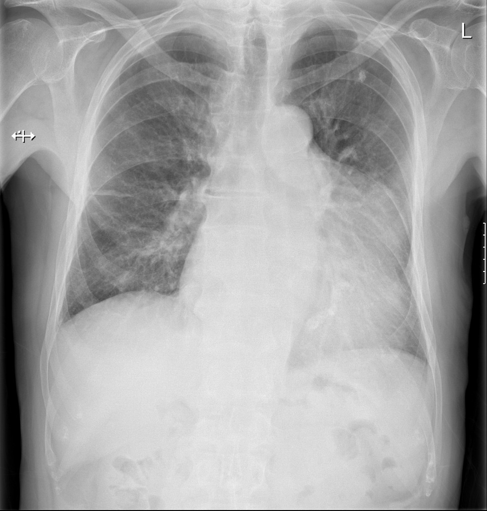 Loculated Pleural Effusion Radiology Case Radiopaedia Org