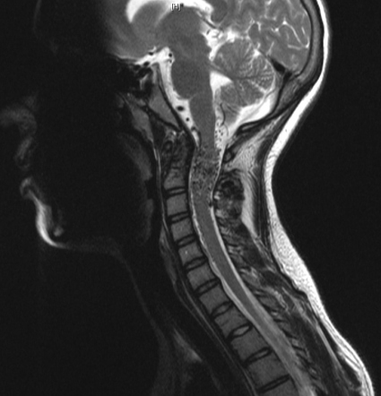 Spinal Arteriovenous Malformations A Comparison Of Dural Arteriovenous ...