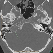 Glomus jugulare paraganglioma | Radiology Reference Article ...